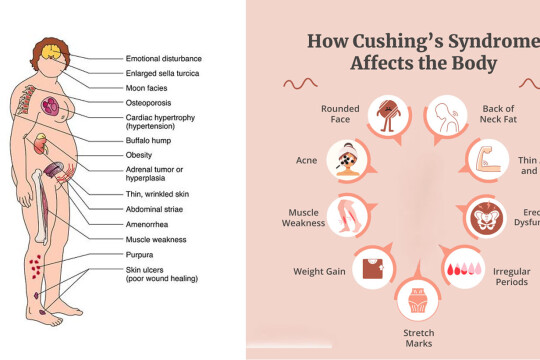 কুশিং সিনড্রোম: লক্ষণ, কারণ, চিকিৎসা এবং প্রতিরোধ - সম্পূর্ণ গাইড