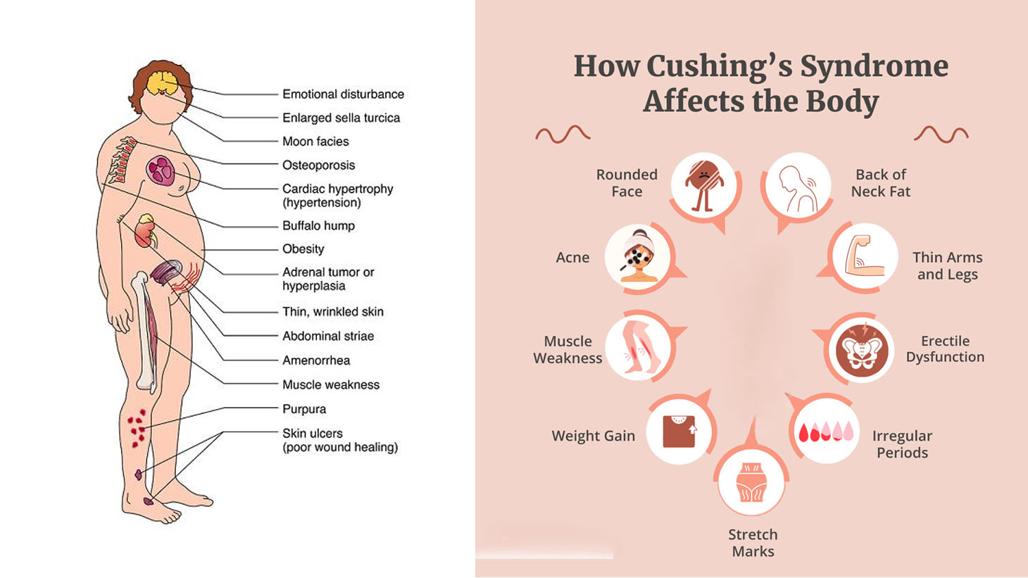 কুশিং সিনড্রোম: লক্ষণ, কারণ, চিকিৎসা এবং প্রতিরোধ - সম্পূর্ণ গাইড